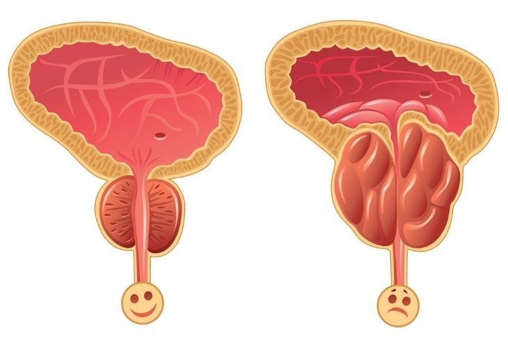 Hình ảnh tuyến tiền liệt bị phì đại