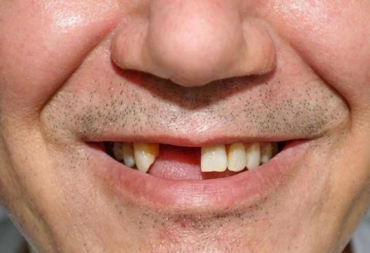 Hình ảnh bệnh nhân bị mất răng