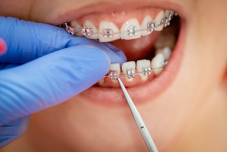 Thực hiện kỹ thuật chỉnh nha không đúng là nguyên nhân niềng răng bị hóp má
