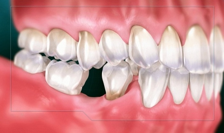Mất răng lâu ngày cũng ảnh hưởng đến cấu trúc răng