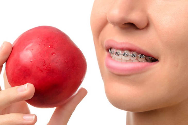 Thói quen ăn nhai khi niềng răng không khoa học gây hóp má