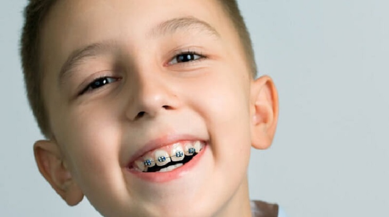 Thời gian niềng răng của trẻ em thường trong khoảng 1 đến 3 năm
