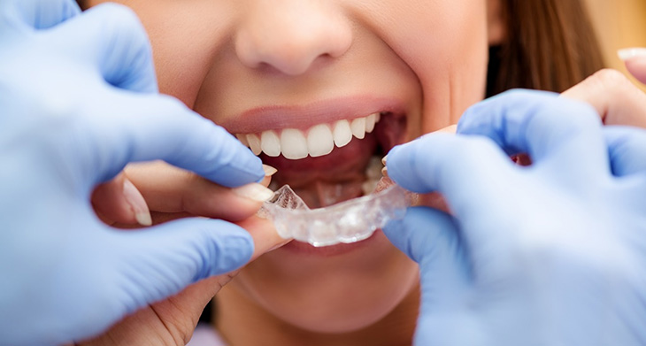 Quá trình niềng răng khấp khểnh gồm 6 bước cơ bản