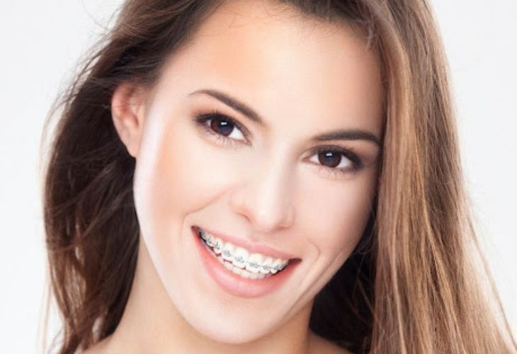 Niềng răng khớp cắn sâu là phương pháp hiệu quả để mang lại nụ cười tự tin cho nhiều người