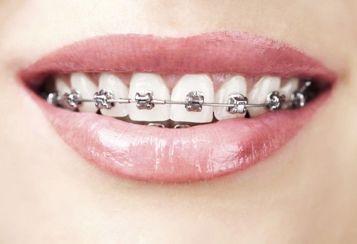 Phương pháp niềng răng với mắc cài kim loại mặt ngoài cho hiệu quả cao