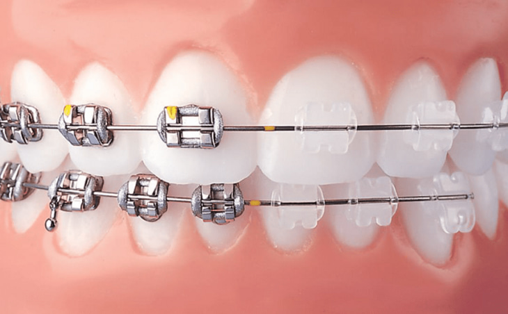 Niềng răng mắc cài là phương pháp chỉnh nha phổ biến hiện nay