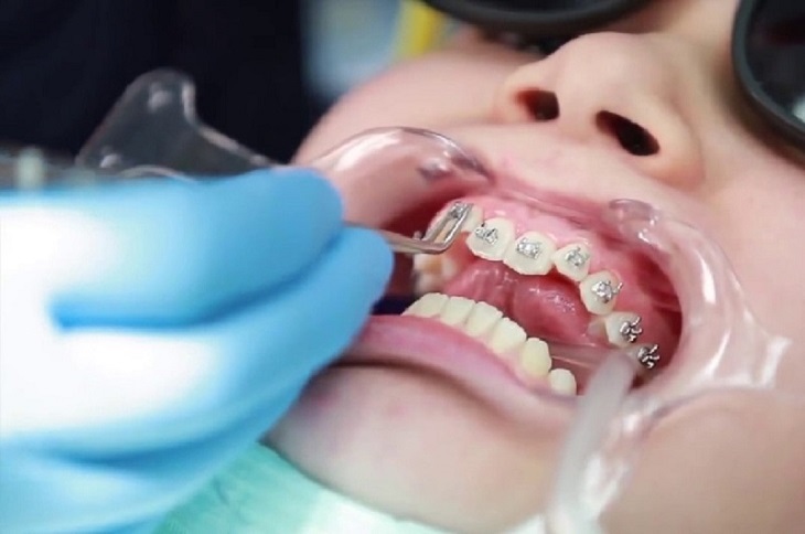 Quy trình niềng răng mắc cài cần được thực hiện bởi bác sĩ tay nghề cao