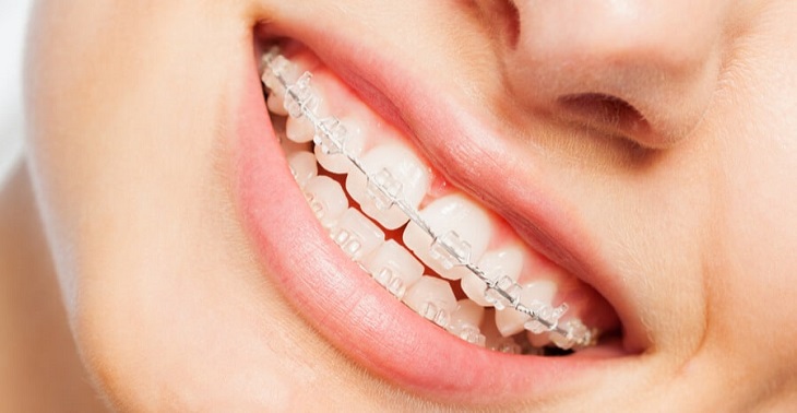 Niềng răng mắc cài sứ tự buộc là kỹ thuật chỉnh nha được nhiều người áp dụng hiện nay
