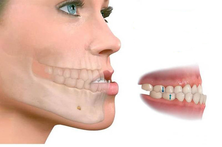 Hình ảnh mô phỏng niềng răng móm