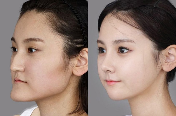 Hình ảnh trước và sau niềng răng móm cải thiện rõ rệt