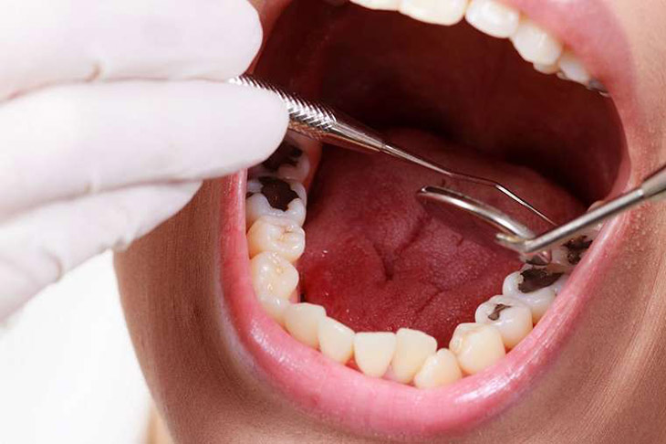 Bệnh nhân sẽ phải nhổ bỏ răng trong những trường hợp cần thiết
