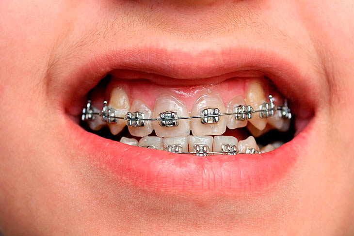 Thời gian niềng răng móm mất khoảng 6 - 24 tháng hoặc lâu hơn
