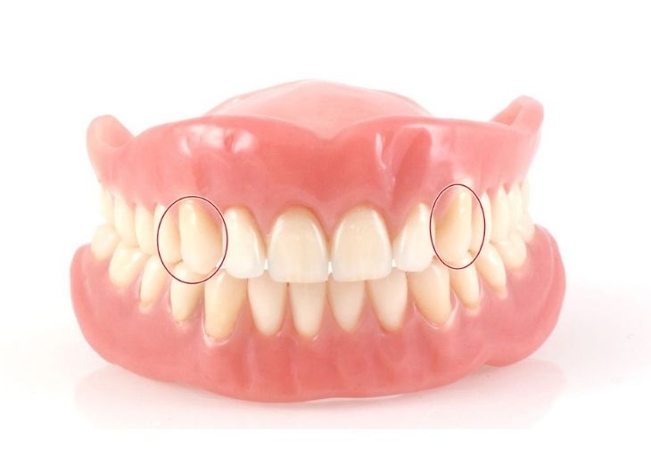 Giải đáp thắc mắc xung quanh niềng răng nhổ răng số 3