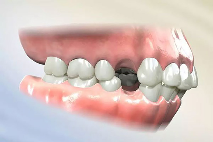 Niềng răng nhổ răng số 4 để tạo khoảng trống dịch chuyển các chân răng lệch lạc về đúng vị trí