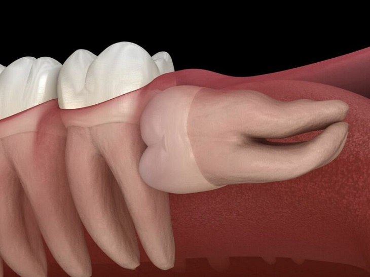 Răng khôn mọc ngầm, mọc lệch cần sớm được nhổ bỏ