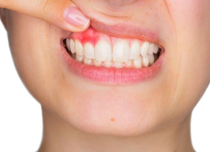 Niềng răng tại nhà tiềm ẩn nguy cơ gây hại cho nướu, lợi