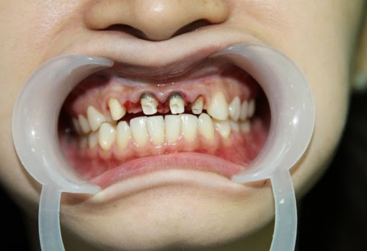Việc tự niềng răng ở nhà có thể gây ra biến chứng nguy hiểm như viêm tủy răng