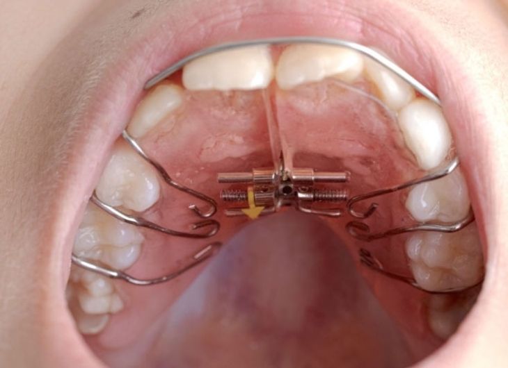 Niềng răng bằng khí cụ tháo lắp kim loại chỉ thích hợp với đối tượng bệnh nhân là trẻ em