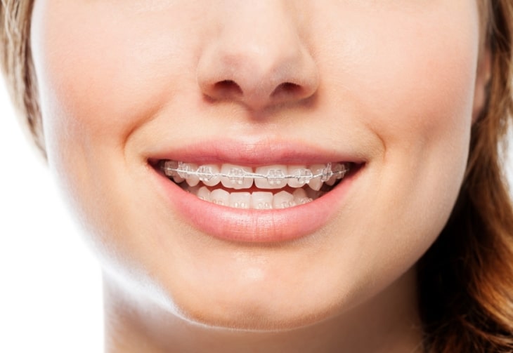 Niềng răng mắc cài  mặt ngoài được dùng phổ biến là mắc cài kim loại và mắc cài sứ/pha lê