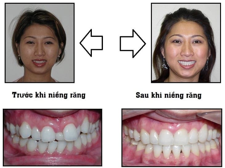 Niềng răng trước và sau mang lại những hình ảnh khác biệt