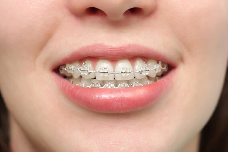 Sau khi niềng răng, các răng được sắp xếp một cách đều đặn, thẳng hàng