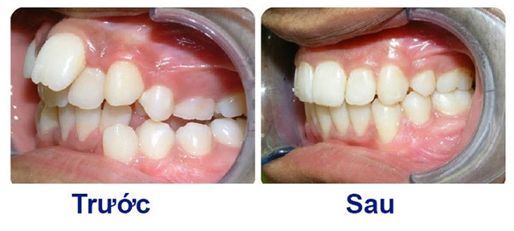 Hình ảnh niềng răng trước và sau với răng mọc chen chúc nhau