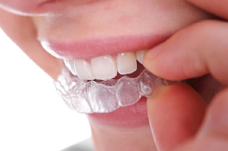 Niềng răng vô hình là kỹ thuật chỉnh nha giúp khắc phục tình trạng răng không đồng đều
