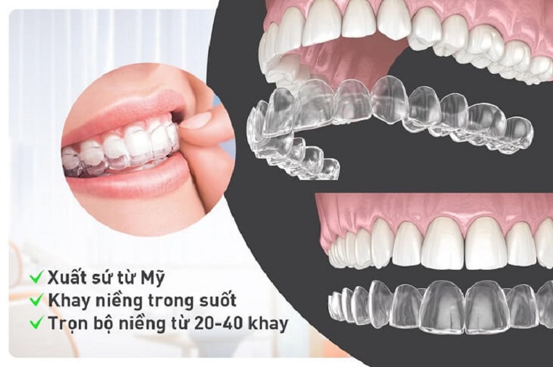 Một quy trình niềng răng trong suốt diễn ra theo 5 bước