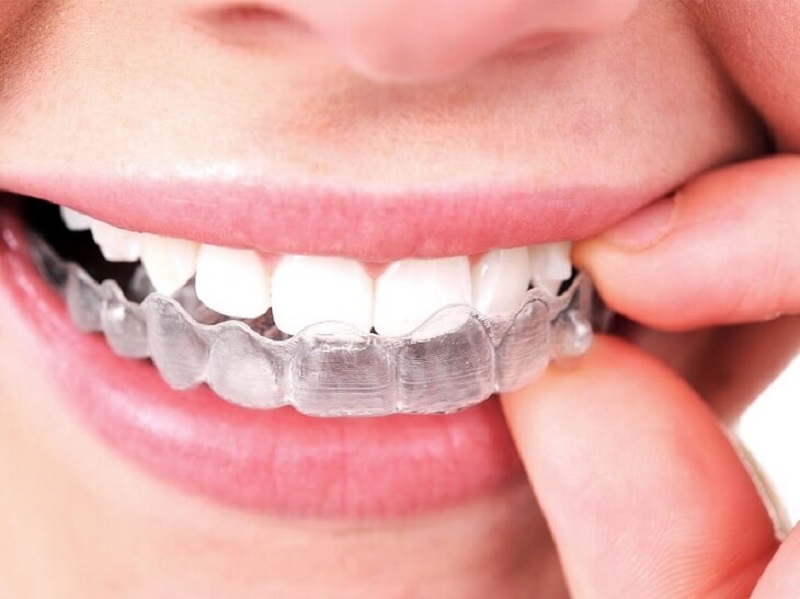 Giá niềng răng trong suốt dao động trong khoảng từ 30 đến 120 triệu đồng