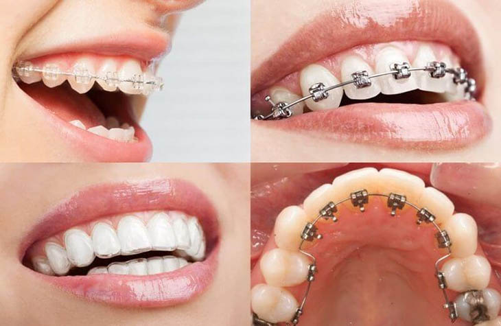 Tìm hiểu “quy trình niềng răng như thế nào”