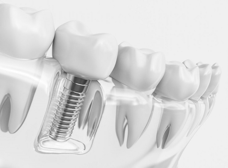 Cấy ghép răng Implant cần làm theo đúng quy trình để có hiệu quả cao nhất