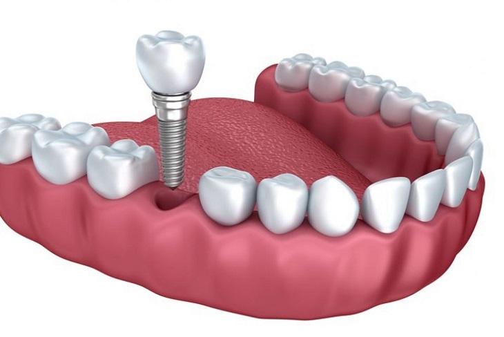 Sau khi trồng răng Implant cần vệ sinh răng miệng sạch sẽ