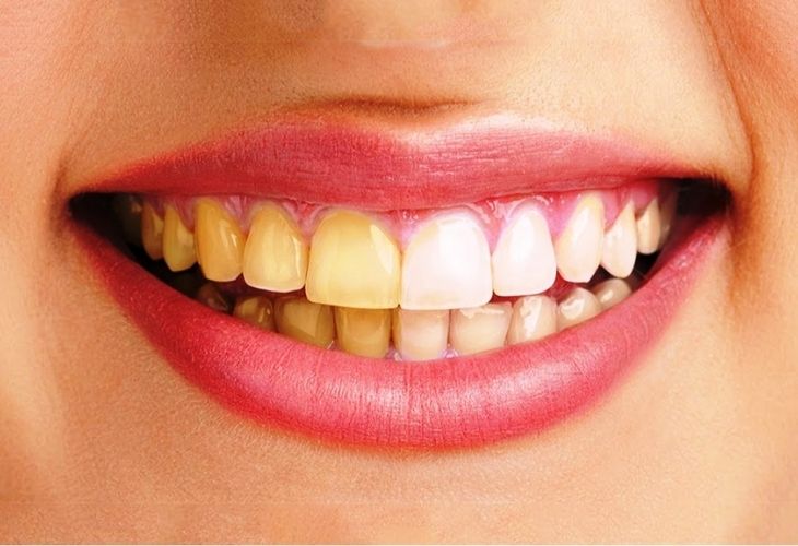 Răng ố vàng là tình trạng chuyển màu sang ngà, vàng hoặc nâu đen 