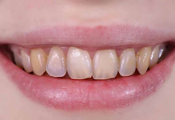 Tình trạng răng ố vàng sẽ xuất hiện khi bạn sử dụng quá nhiều thức uống hoặc kem đánh răng có chứa thành phần flouride