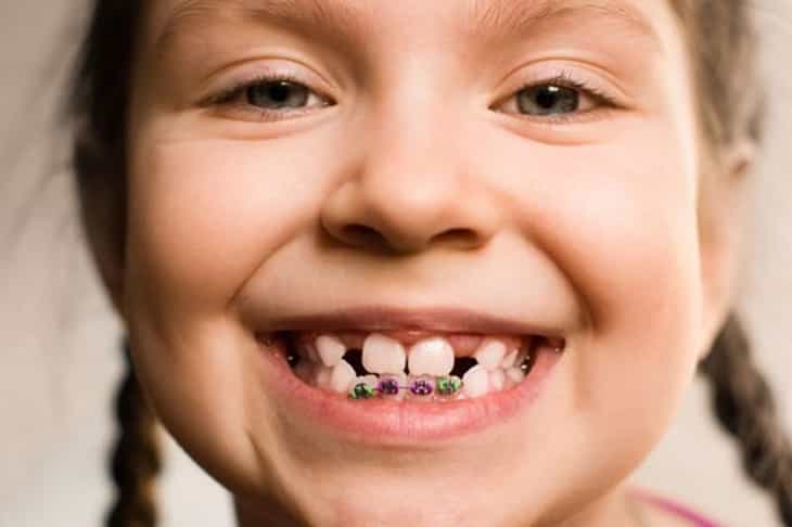 Niềng răng là biện pháp an toàn giúp khắc phục tình trạng răng bé mọc không đúng vị trí