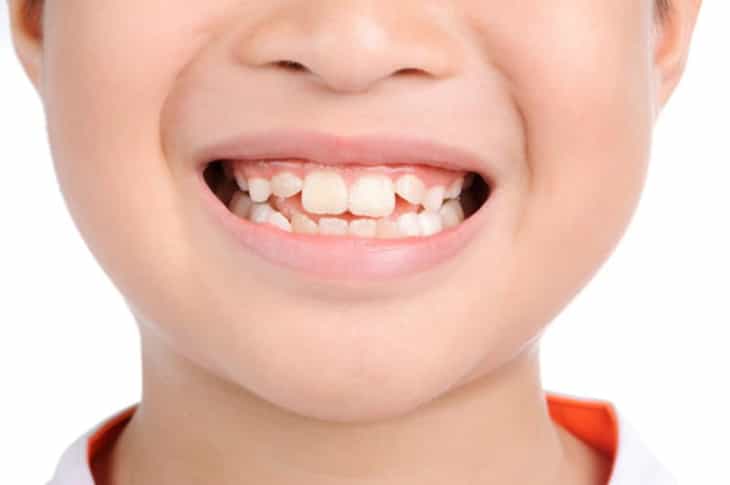 Việc nhổ những chiếc răng không lung lay cần được thực hiển bởi các bác sĩ chuyên khoa