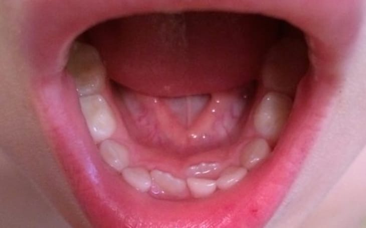 Răng trẻ mọc lẫy làm giảm chức năng nhai nghiền thức ăn