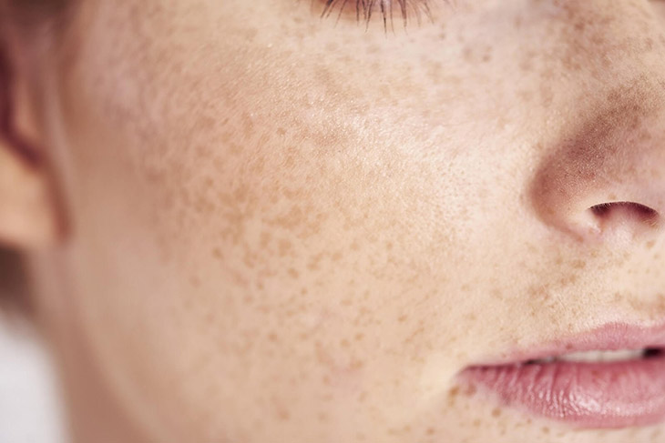 Tàn nhang xuất hiện trên da do tăng sinh sắc tố melanin