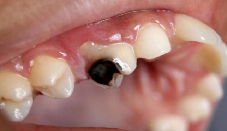 Sâu Răng Ăn Vào Tủy Là Như Thế Nào? Phương Pháp Điều Trị Ra Sao?