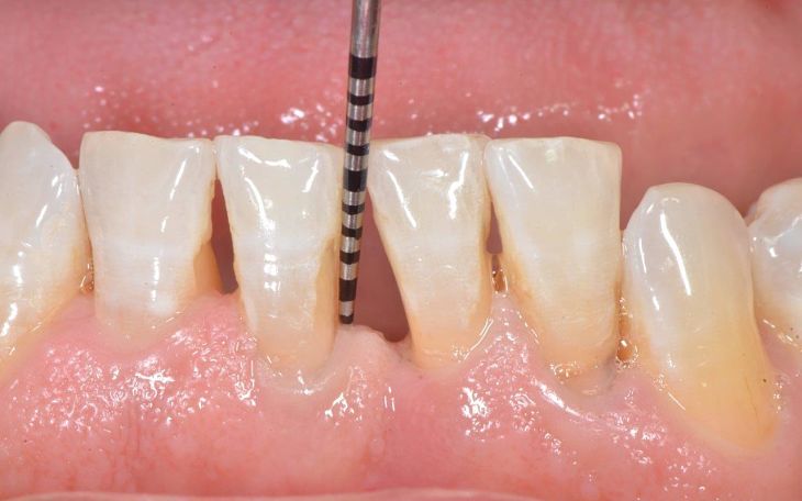 Tiêu chân răng là một trong các tác hại của niềng răng thường gặp