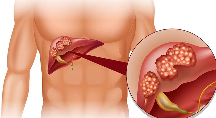 Viêm gan B gây ra nhiều tác hại khó lường đối với sức khỏe