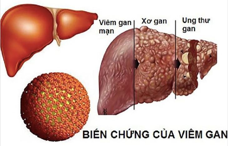 Viêm gan B chuyển qua giai đoạn mãn tính sẽ thành xơ gan