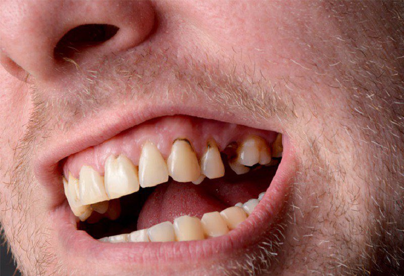 Thiểu sản men răng là hiện tượng cấu trúc men răng bị lỗi, hoặc không hoàn thiện dẫn tới thiếu hụt lượng men răng