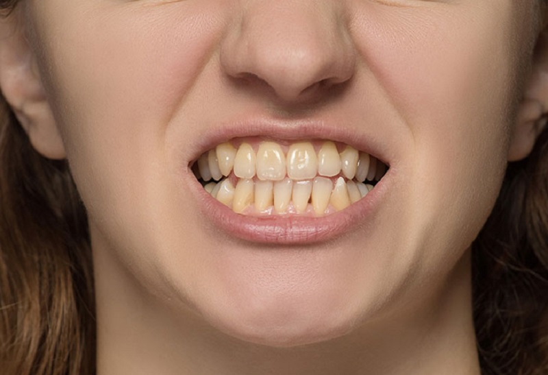 Bề mặt răng xuất hiện đốm màu đen, vàng là một biểu hiện của bệnh