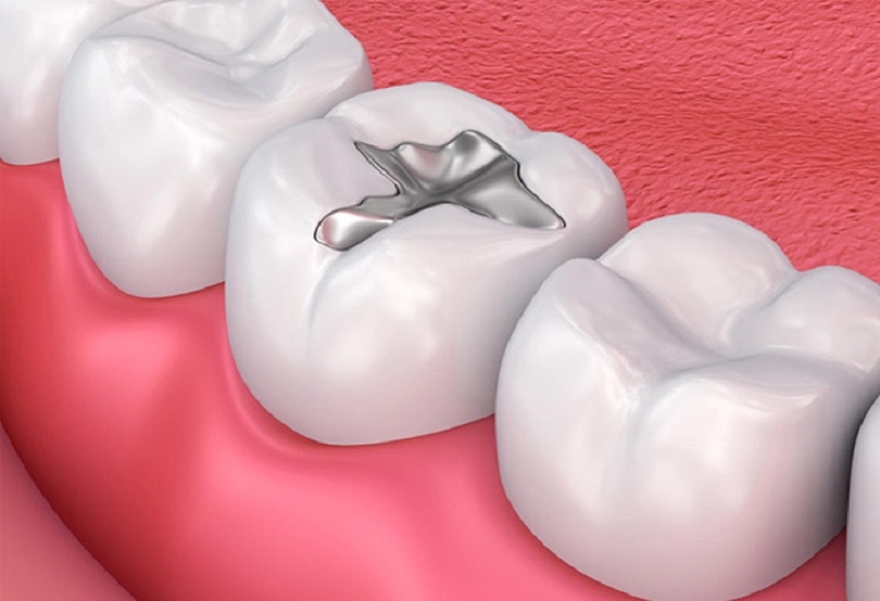 Trám răng là biện pháp điều trị vô cùng hiệu quả