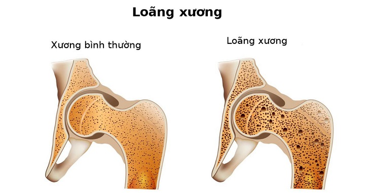 Bệnh nhân loãng xương chính là đối tượng cần và nên sử dụng loại thuốc này