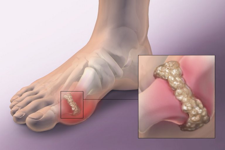 Thuốc gout lá nương giúp giảm những triệu chứng do bệnh gout gây ra