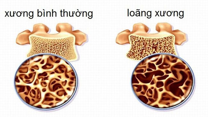 Alendronate là loại thuốc chuyên điều trị bệnh loãng xương