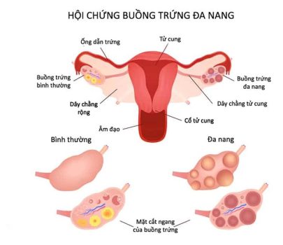 Buồng trứng đa nang ở phụ nữ