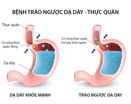 trào ngược dạ dày thực quản khi ngủ là tình trạng nghiêm trọng